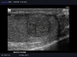 Ultrazvok testisov - tumor desnega testisa 2